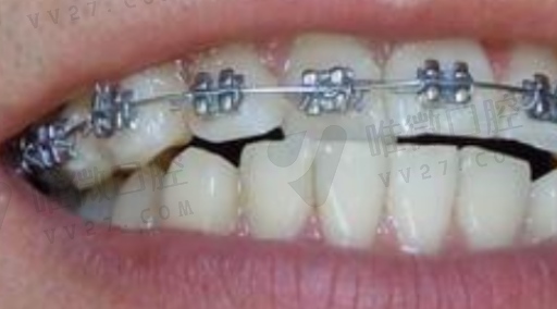 正畸牙套的种类和优劣势（正畸牙齿用哪种牙套好）(图1)